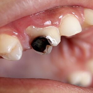 Dental_Caries_Cavity_2.JPG